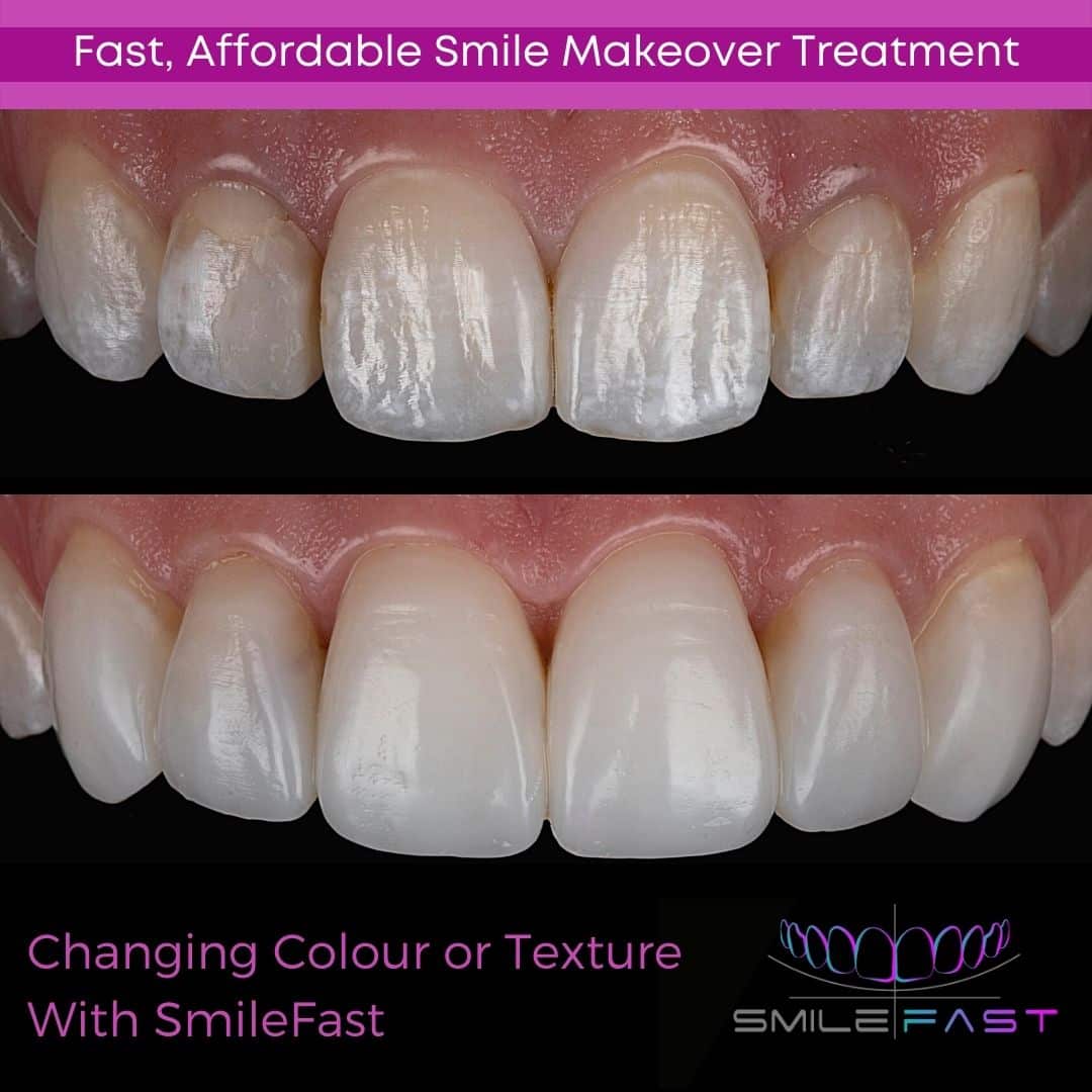 SmileFast - Hampshire Dentists Pain Free Dentist in Southampton Before and after depiction of SmileFast treatment, demonstrating a transformation in the colour and texture of teeth.