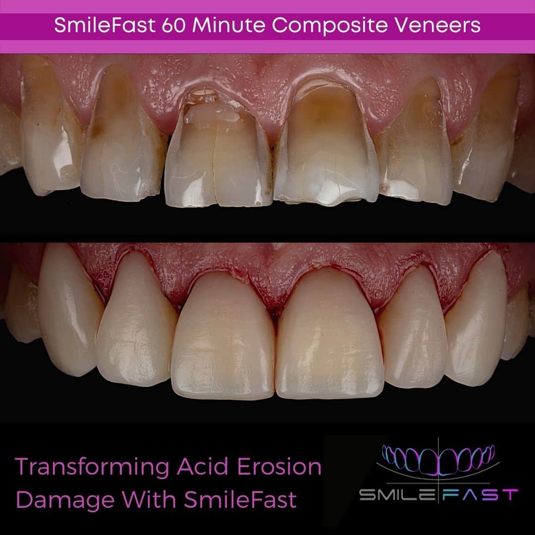 SmileFast - Hampshire Dentists Pain Free Dentist in Southampton Before and after depiction of SmileFast treatment, demonstrating management of dental erosion