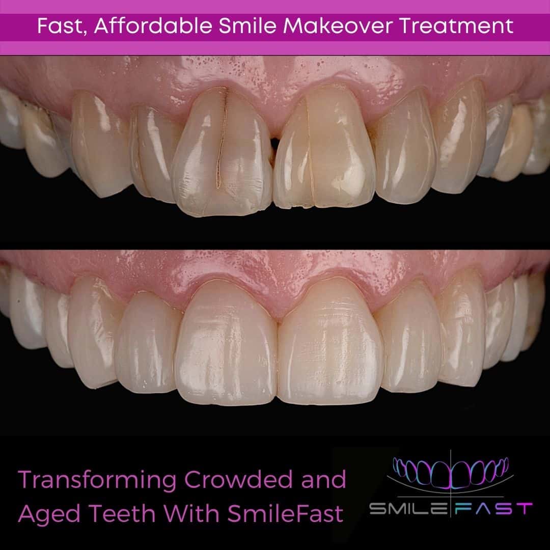 SmileFast - Hampshire Dentists Pain Free Dentist in Southampton Before and after depiction of SmileFast treatment, demonstrating covering aged, discoloured teeth and camouflage or mild crowding