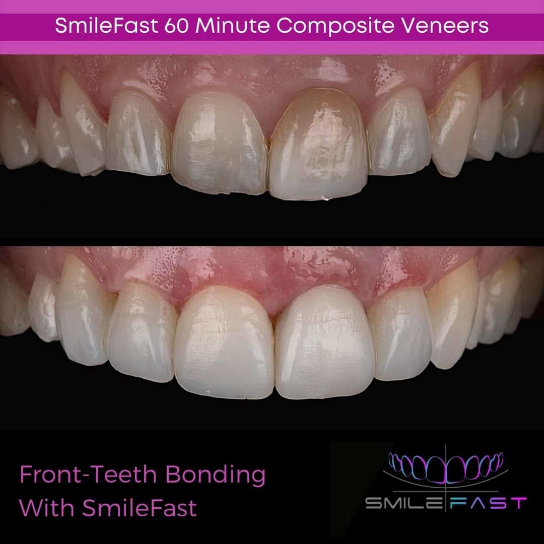 SmileFast - Hampshire Dentists Pain Free Dentist in Southampton Before and after depiction of SmileFast treatment, demonstrating transformation of uneven front teeth