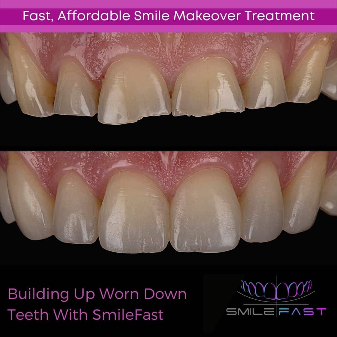 SmileFast - Hampshire Dentists Pain Free Dentist in Southampton Before and after depiction of SmileFast treatment, demonstrating building up worn teeth with composite veneers