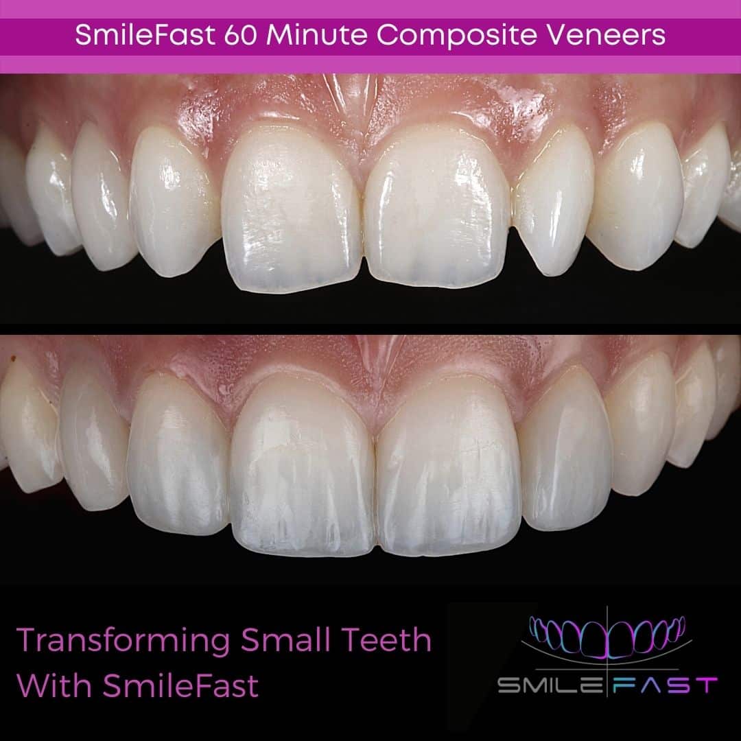 SmileFast - Hampshire Dentists Pain Free Dentist in Southampton Before and after depiction of SmileFast treatment, demonstrating building small teeth