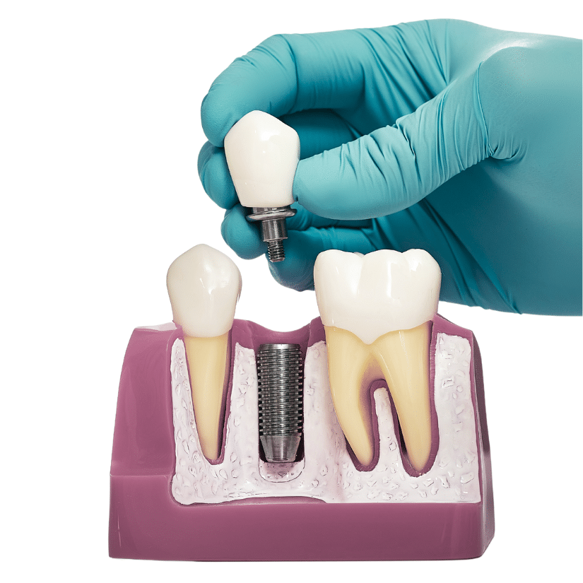 Dental Implants - Hampshire Dentists Pain Free Dentist in Southampton Model of dental implant components