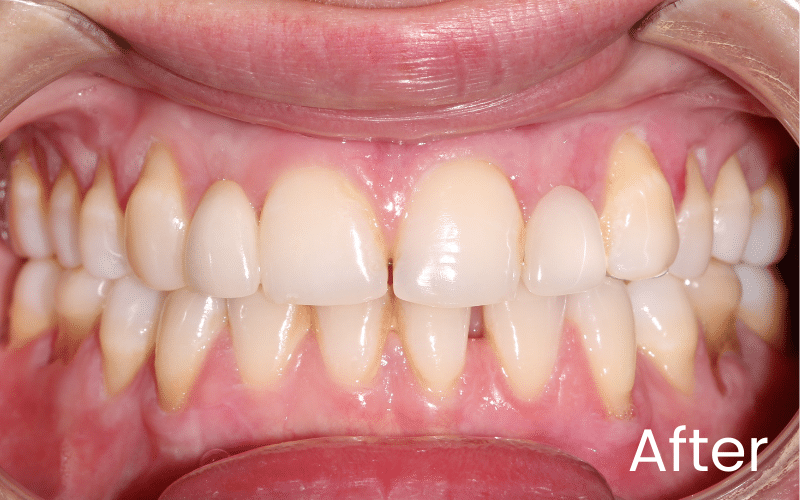 Dental Bridges - Hampshire Dentists Pain Free Dentist in Southampton Upper right lateral incisor replaced with maryland bridge