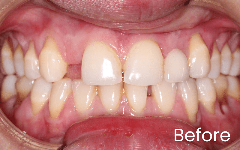 Dental Bridges - Hampshire Dentists Pain Free Dentist in Southampton Upper right lateral incisor missing, full teeth view