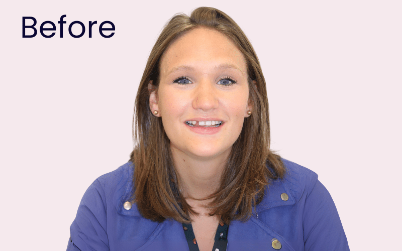 Dental Bridges - Hampshire Dentists Pain Free Dentist in Southampton Upper right lateral incisor missing, full face view