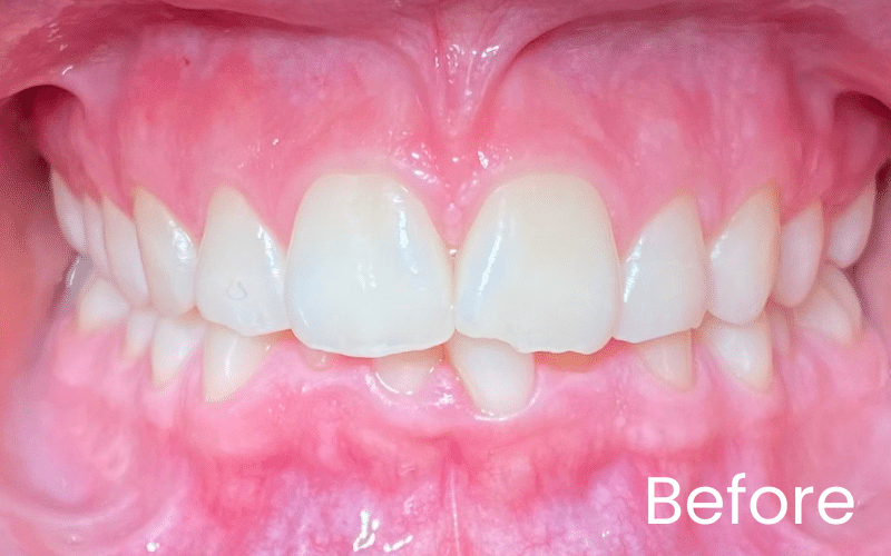 Invisalign - Hampshire Dentists Pain Free Dentist in Southampton Invisalign - Hampshire Dentists Pain Free Dentist in Southampton