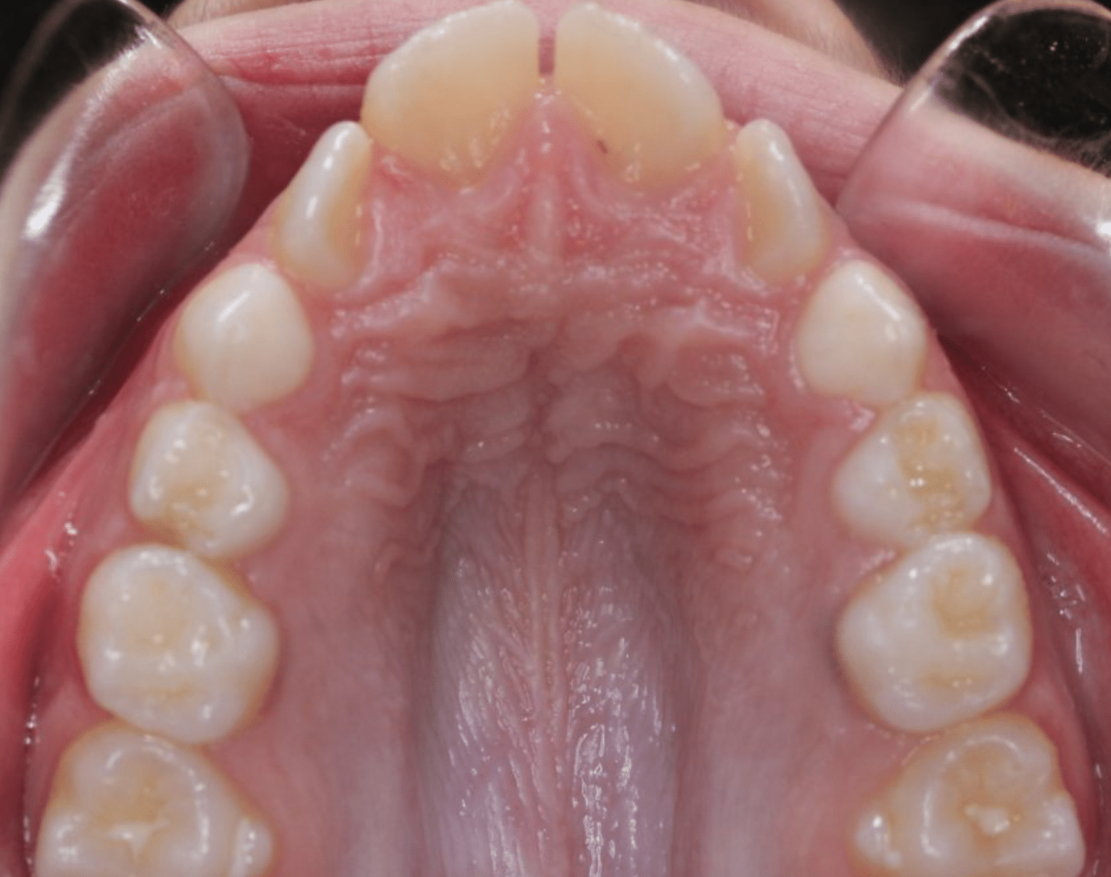 Children’s Braces - Hampshire Dentists Pain Free Dentist in Southampton Image of palate with upper teeth showing narrow shape with crowded teeth