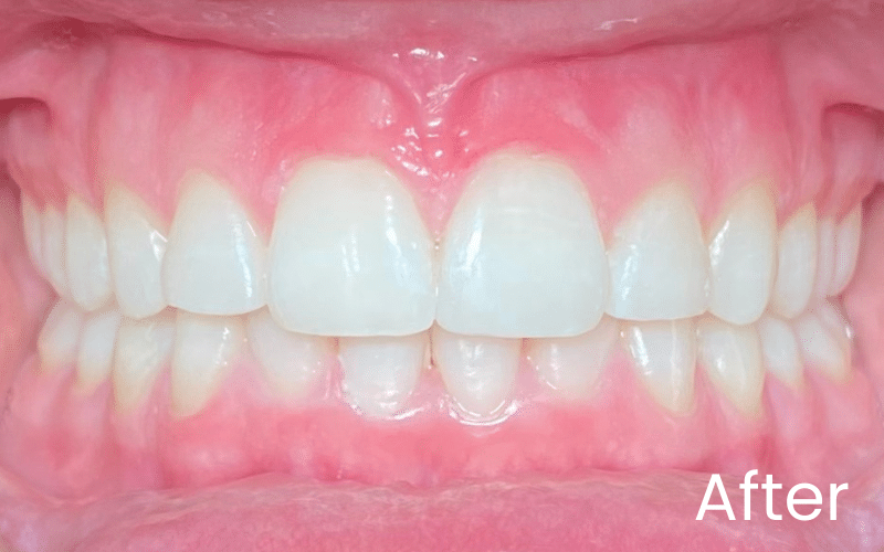 Invisalign - Hampshire Dentists Pain Free Dentist in Southampton Front full retracted image of teeth after Invisalign treatment