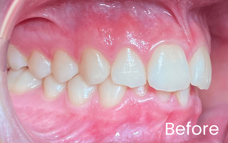 Invisalign - Hampshire Dentists Pain Free Dentist in Southampton Invisalign - Hampshire Dentists Pain Free Dentist in Southampton
