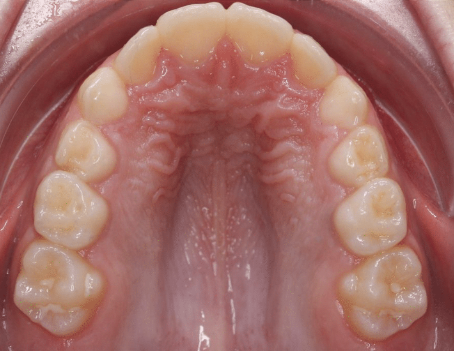 Children’s Braces - Hampshire Dentists Pain Free Dentist in Southampton Image of palate with upper teeth showing expanded palate after hyrax treatment