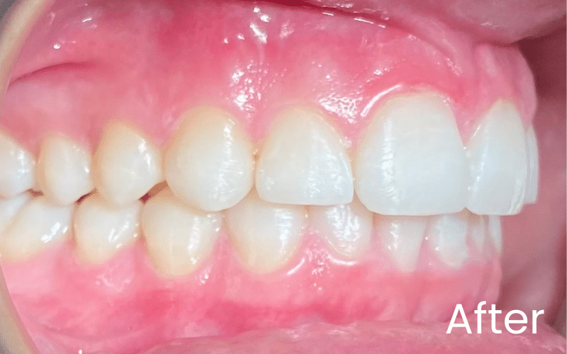 Invisalign - Hampshire Dentists Pain Free Dentist in Southampton Right retracted image of teeth after Invisalign treatment at Hampshire Dentists