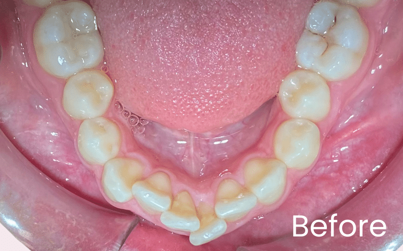 Invisalign - Hampshire Dentists Pain Free Dentist in Southampton Invisalign - Hampshire Dentists Pain Free Dentist in Southampton