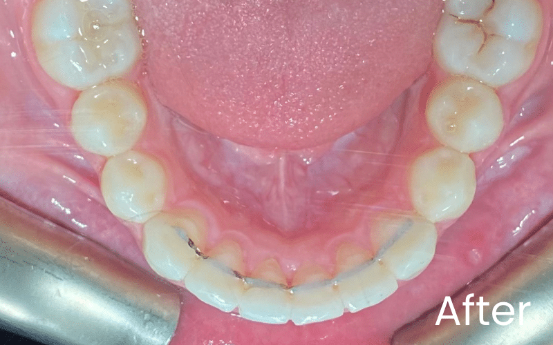 Invisalign - Hampshire Dentists Pain Free Dentist in Southampton Lower teeth from top view after Invisalign treatment with fixed retainer