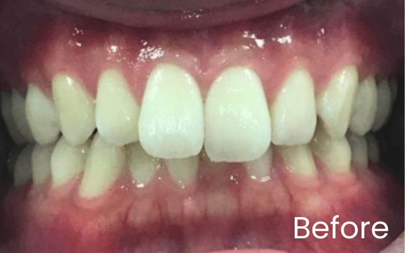 Invisalign - Hampshire Dentists Pain Free Dentist in Southampton Invisalign - Hampshire Dentists Pain Free Dentist in Southampton