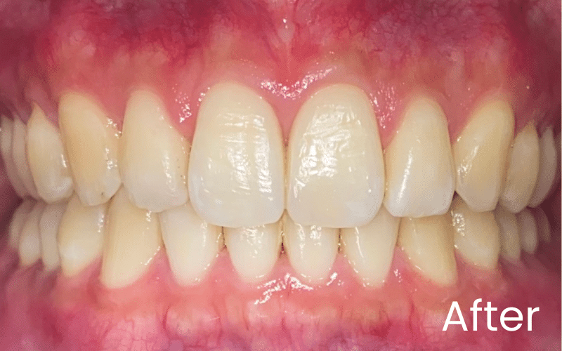 Invisalign - Hampshire Dentists Pain Free Dentist in Southampton Front full retracted image of teeth after teeth straightening with Invisalign