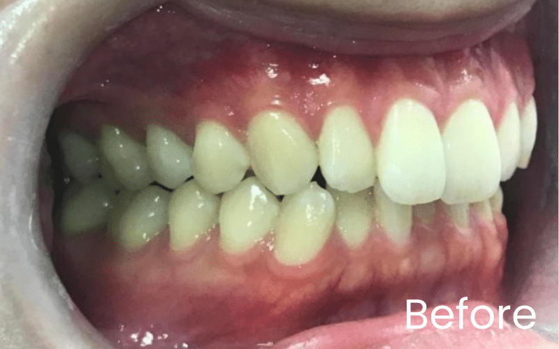 Invisalign - Hampshire Dentists Pain Free Dentist in Southampton Invisalign - Hampshire Dentists Pain Free Dentist in Southampton