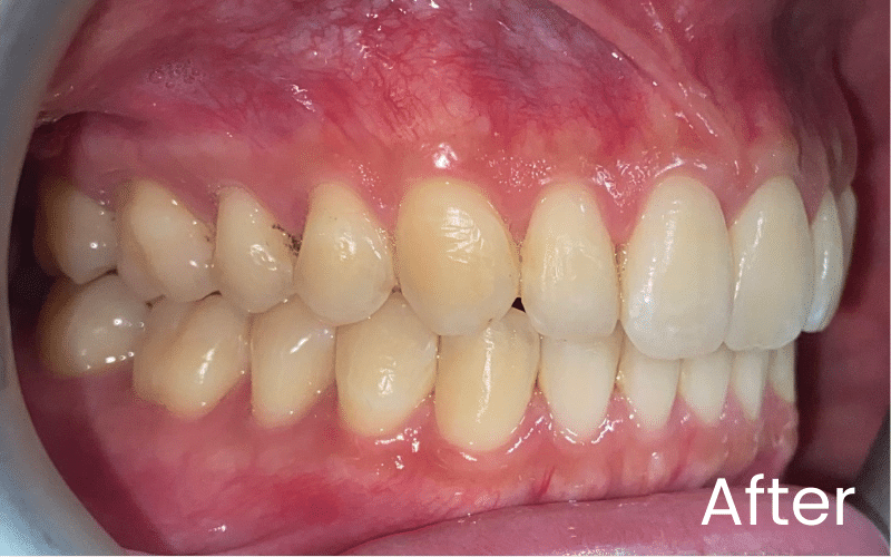 Invisalign - Hampshire Dentists Pain Free Dentist in Southampton Left retracted image of teeth after treatment with Invisalign in Southampton