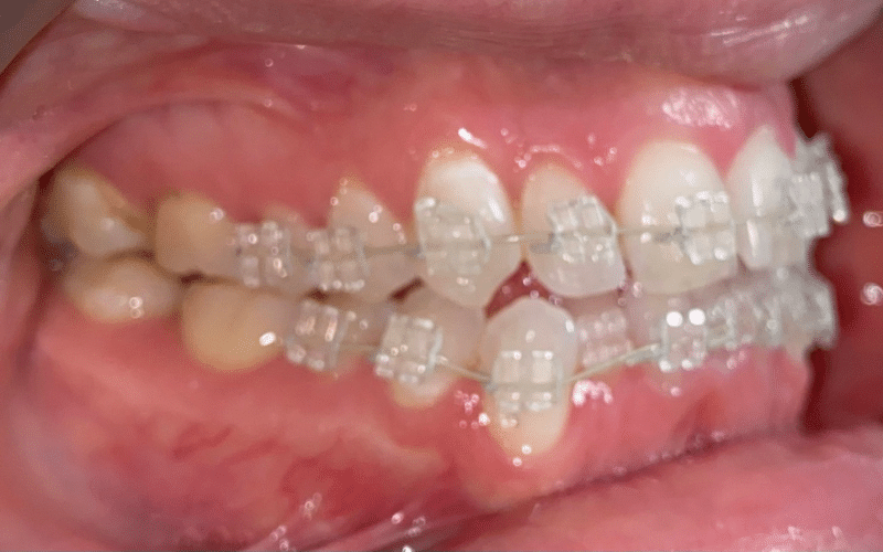 Fixed braces - Hampshire Dentists Pain Free Dentist in Southampton Right retracted view of teeth after fitting clear fixed braces