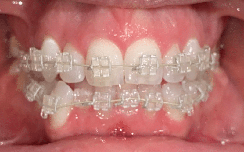 Fixed braces - Hampshire Dentists Pain Free Dentist in Southampton Front retracted view of teeth after fitting clear fixed braces
