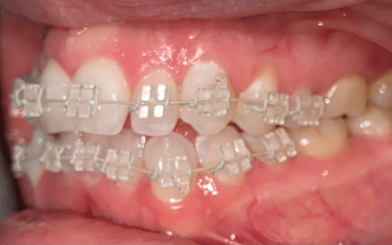 Fixed braces - Hampshire Dentists Pain Free Dentist in Southampton Left retracted view of teeth after fitting clear fixed braces