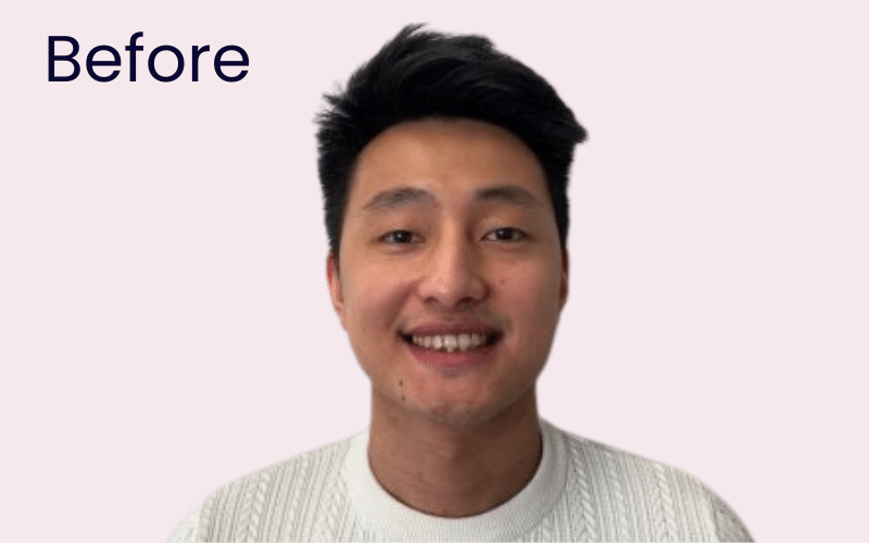 Fixed braces - Hampshire Dentists Pain Free Dentist in Southampton Image of patient before teeth straightening with clear fixed braces