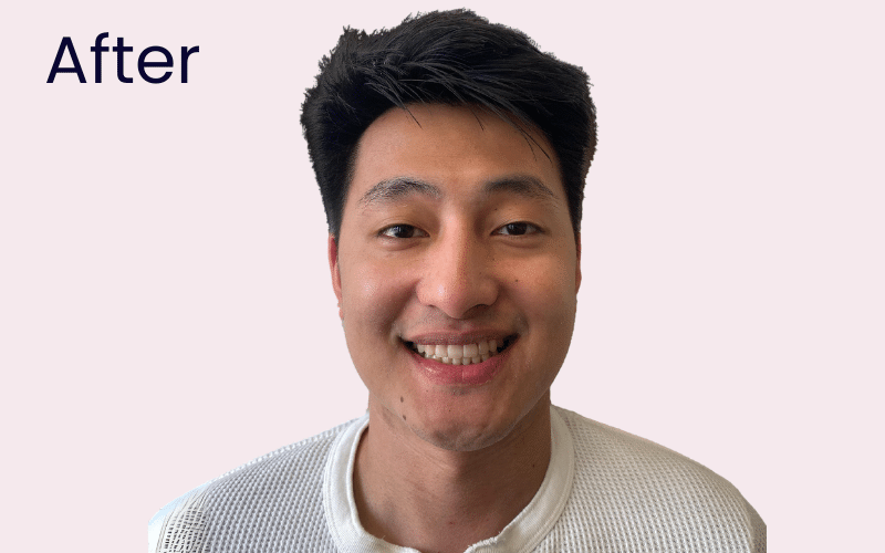 Fixed braces - Hampshire Dentists Pain Free Dentist in Southampton Image of patient after teeth straightening with clear fixed braces