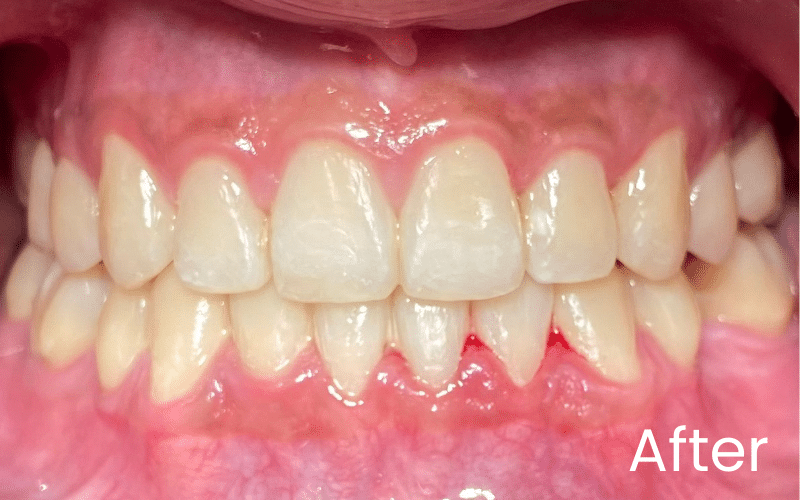 Fixed braces - Hampshire Dentists Pain Free Dentist in Southampton Front full retracted image of teeth after teeth straightening
