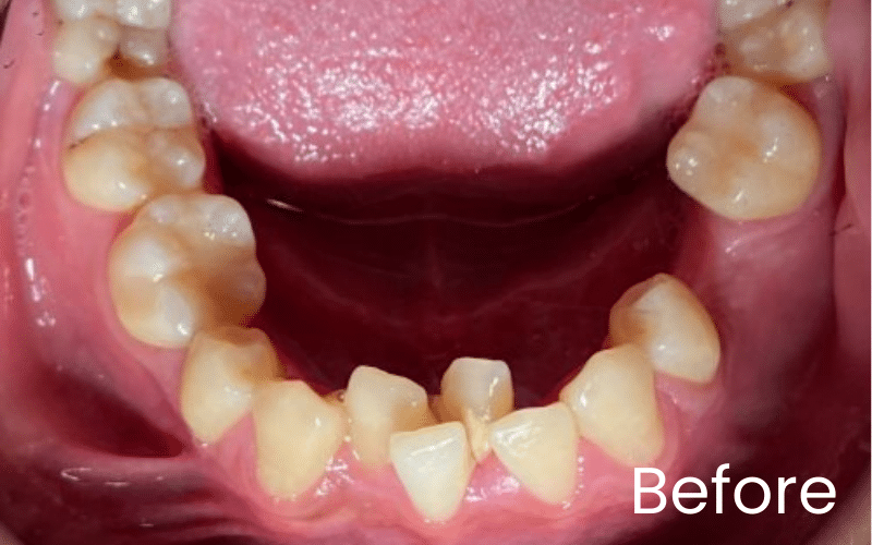 Fixed braces - Hampshire Dentists Pain Free Dentist in Southampton Fixed braces - Hampshire Dentists Pain Free Dentist in Southampton