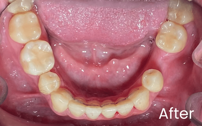 Fixed braces - Hampshire Dentists Pain Free Dentist in Southampton Image of lower teeth with after teeth straightening in Southampton