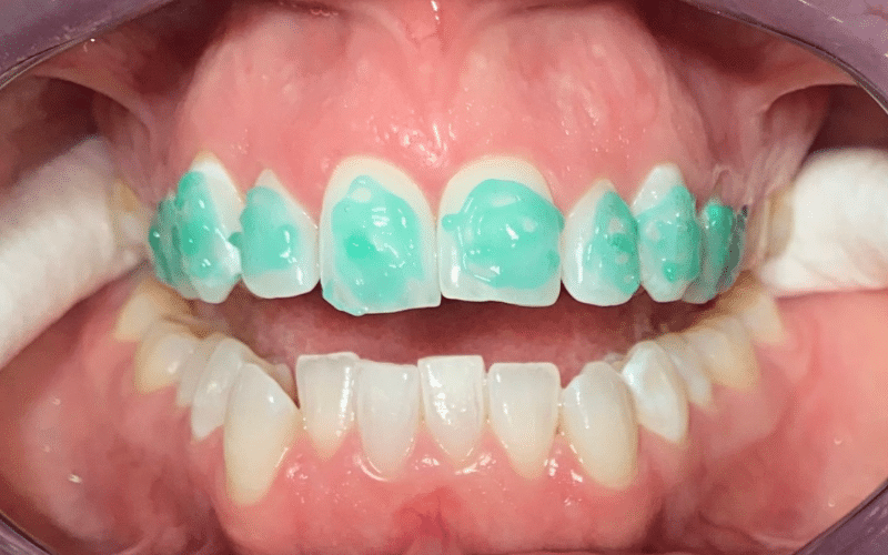 Fixed braces - Hampshire Dentists Pain Free Dentist in Southampton Close up image of teeth showing 1st stage of bonding fixed braces in place - etching the teeth