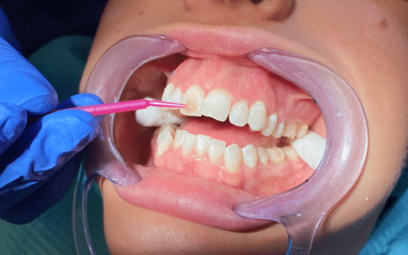 Fixed braces - Hampshire Dentists Pain Free Dentist in Southampton Close up image of teeth showing 2nd stage of bonding fixed braces in place - applying bond