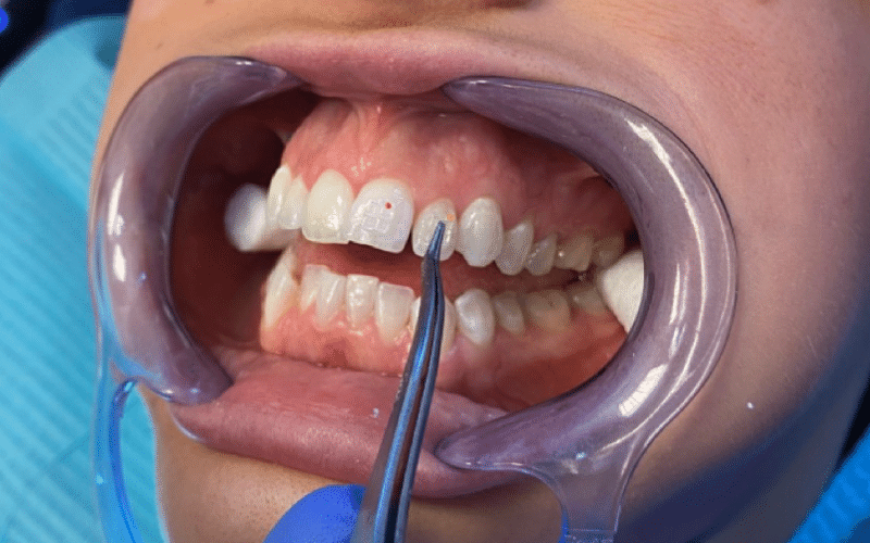Fixed braces - Hampshire Dentists Pain Free Dentist in Southampton Close up image of teeth showing 3rd stage of bonding fixed braces in place - placing the brackets