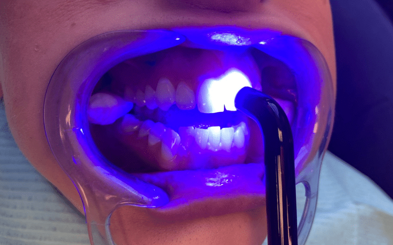 Fixed braces - Hampshire Dentists Pain Free Dentist in Southampton Close up image of teeth showing 4th stage of bonding fixed braces in place - setting the brackets in place