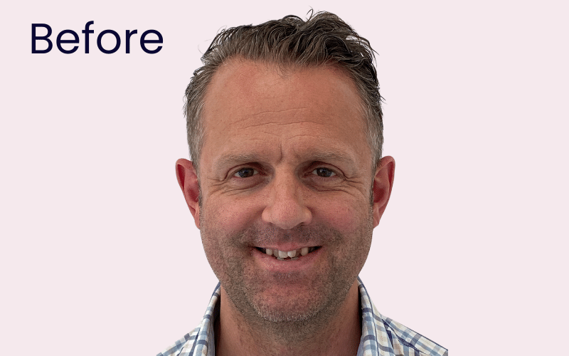 Fixed braces - Hampshire Dentists Pain Free Dentist in Southampton Image of patient before teeth straightening with clear fixed braces