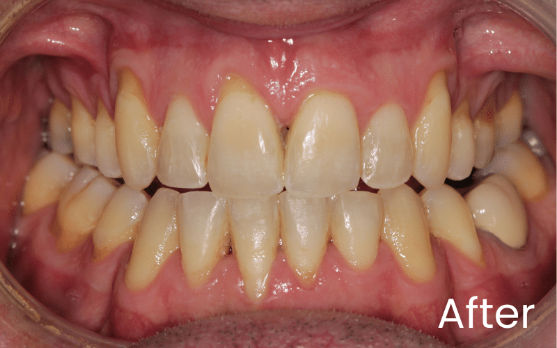 Fixed braces - Hampshire Dentists Pain Free Dentist in Southampton Front full retracted image of teeth with after teeth straightening in Southampton