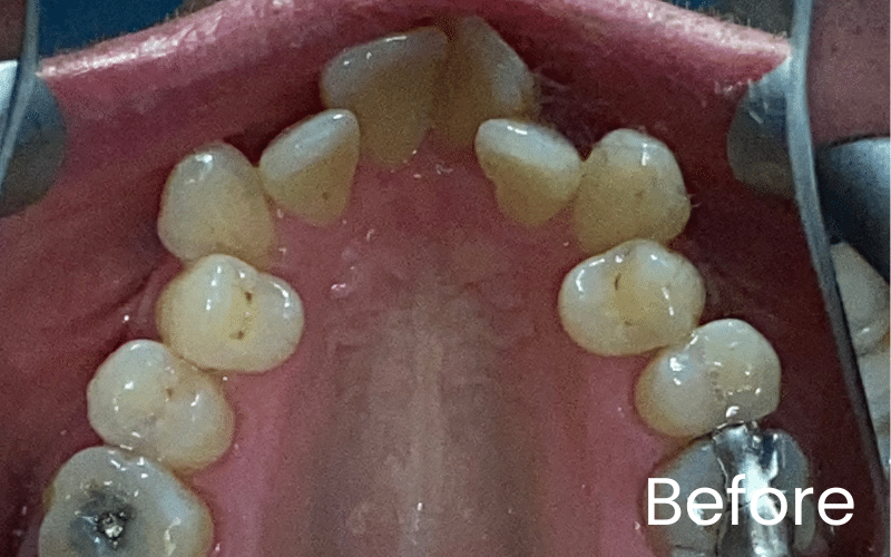Fixed braces - Hampshire Dentists Pain Free Dentist in Southampton Fixed braces - Hampshire Dentists Pain Free Dentist in Southampton