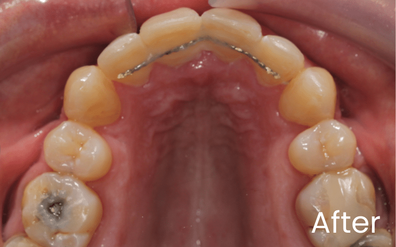 Fixed braces - Hampshire Dentists Pain Free Dentist in Southampton Image of palate with upper teeth showing aligned teeth after fixed braces treatment at Hampshire Dentists