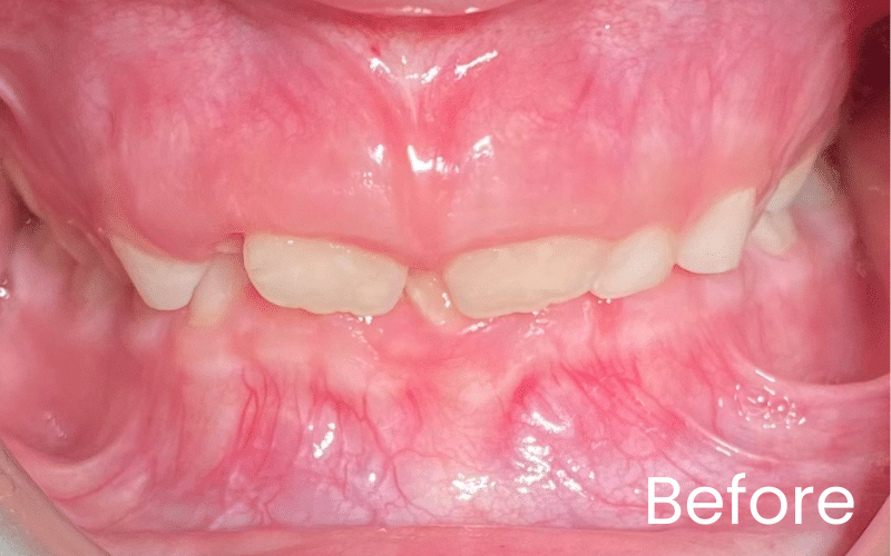 Children’s Braces - Hampshire Dentists Pain Free Dentist in Southampton Children’s Braces - Hampshire Dentists Pain Free Dentist in Southampton