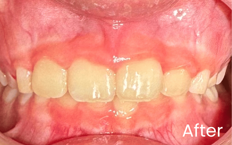 Children’s Braces - Hampshire Dentists Pain Free Dentist in Southampton Front full retracted image of teeth after teeth straightening with Invisalign First
