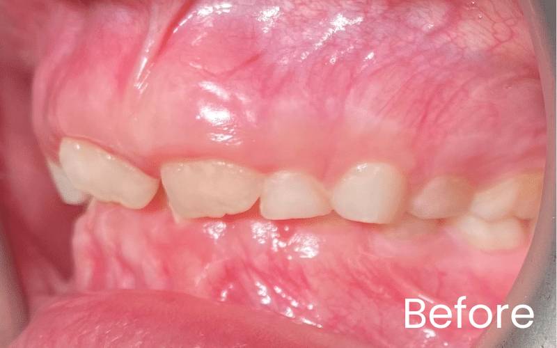 Children’s Braces - Hampshire Dentists Pain Free Dentist in Southampton Left retracted image of teeth with deep overbite before teeth straightening with Invisalign First