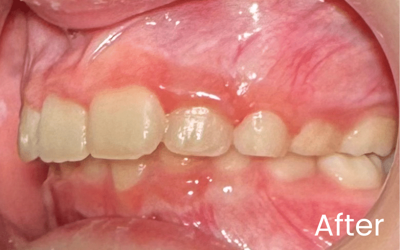 Children’s Braces - Hampshire Dentists Pain Free Dentist in Southampton Left retracted image of teeth after teeth straightening with Invisalign First