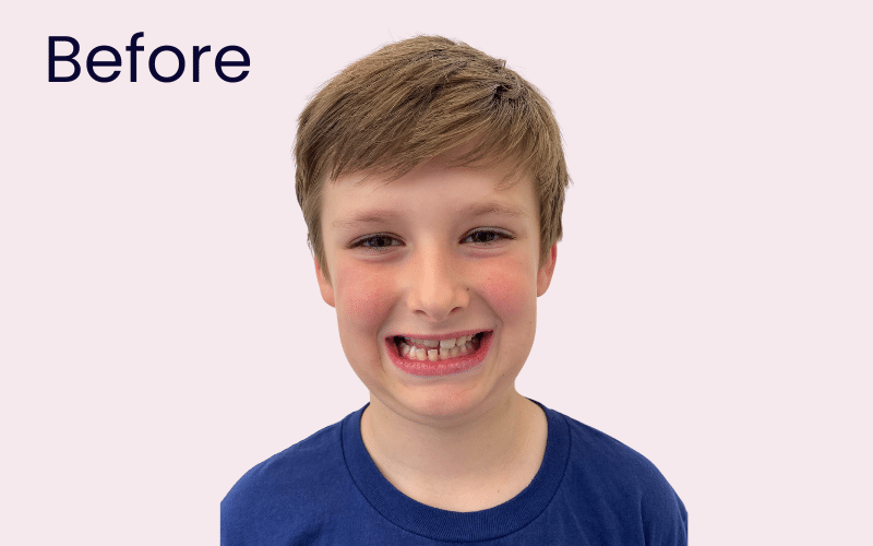 Children’s Braces - Hampshire Dentists Pain Free Dentist in Southampton Image of patient before child teeth straightening with Invisalign First
