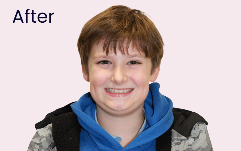 Children’s Braces - Hampshire Dentists Pain Free Dentist in Southampton Image of patient after child teeth straightening with Invisalign First