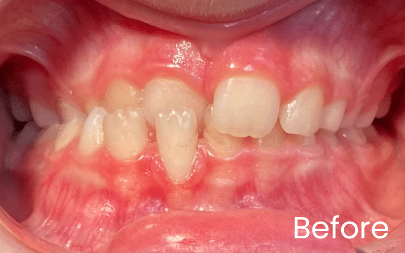 Children’s Braces - Hampshire Dentists Pain Free Dentist in Southampton Children’s Braces - Hampshire Dentists Pain Free Dentist in Southampton