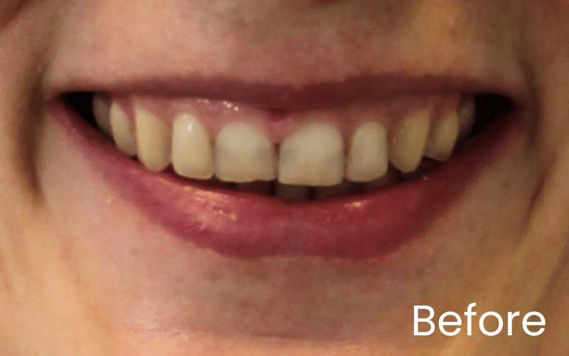 Teeth Whitening - Hampshire Dentists Pain Free Dentist in Southampton Image of close up smile before teeth whitening at Hampshire Dentists in Southampton