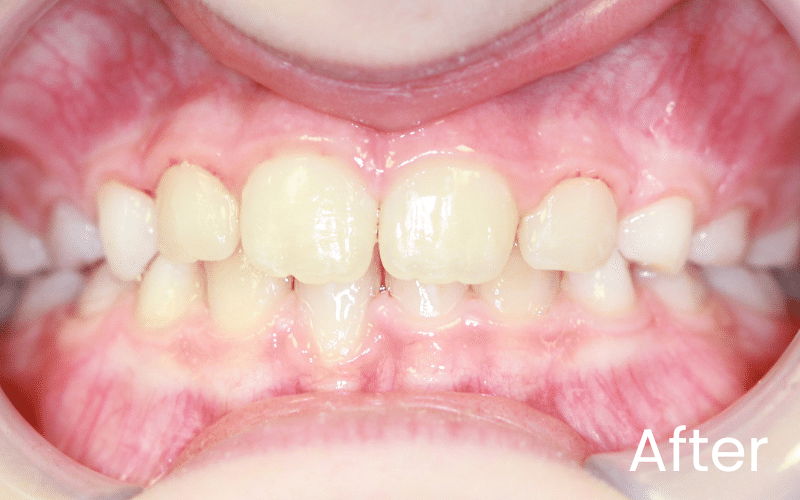 Children’s Braces - Hampshire Dentists Pain Free Dentist in Southampton Front full retracted image of teeth after straightening with Invisalign First in Southampton