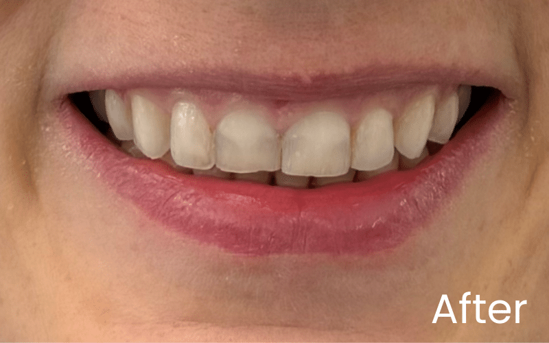 Teeth Whitening - Hampshire Dentists Pain Free Dentist in Southampton Image of close up smile after teeth whitening at Hampshire Dentists in Southampton