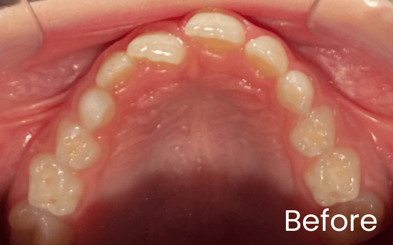 Children’s Braces - Hampshire Dentists Pain Free Dentist in Southampton Image of all upper teeth and palate with cross bite before teeth straightening with Invisalign First