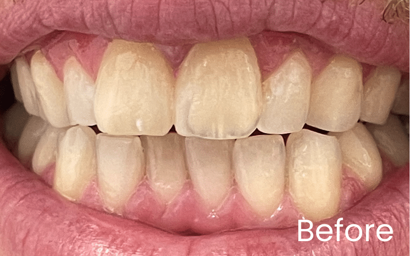 Teeth Whitening - Hampshire Dentists Pain Free Dentist in Southampton Image of close up smile before teeth whitening treatment in Southampton